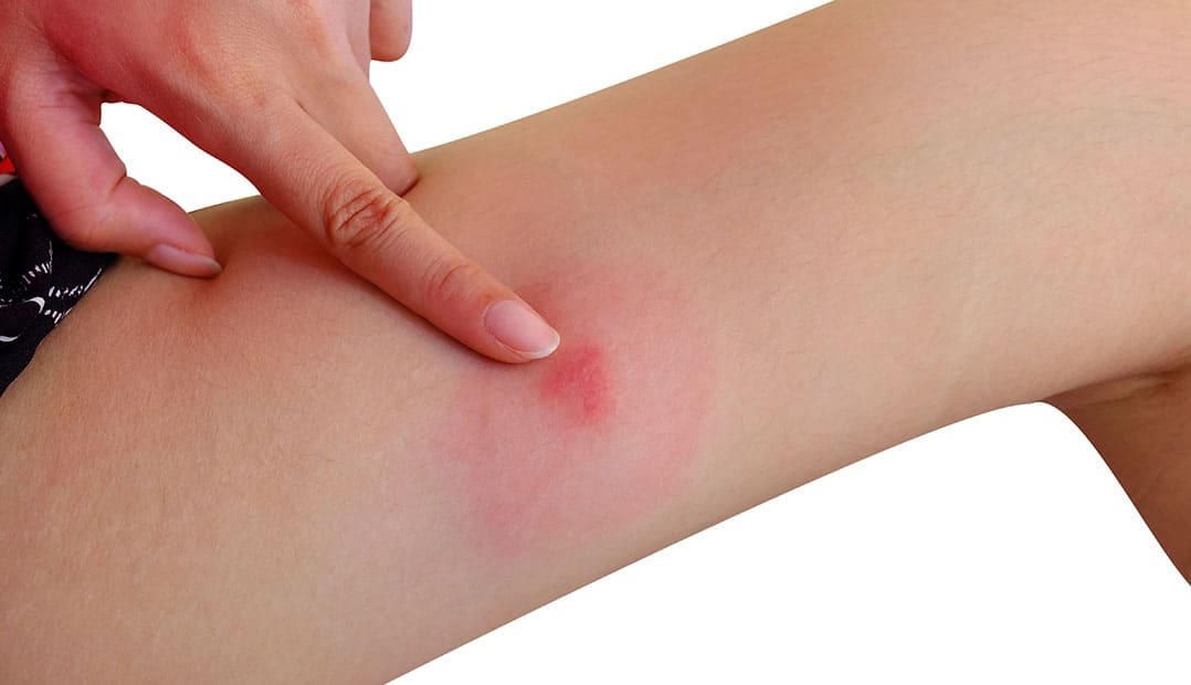 Soothes Bug bites